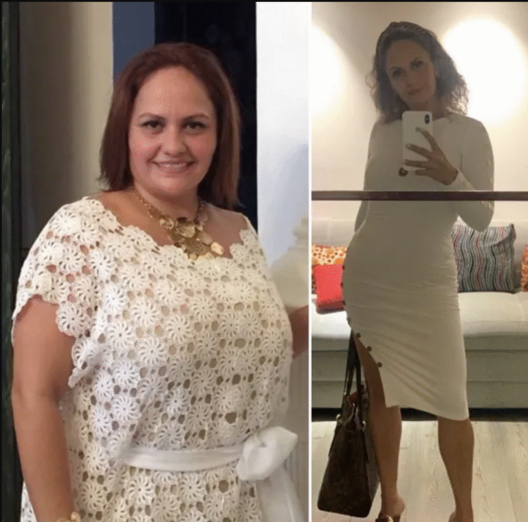 gastric-surgery-before-after